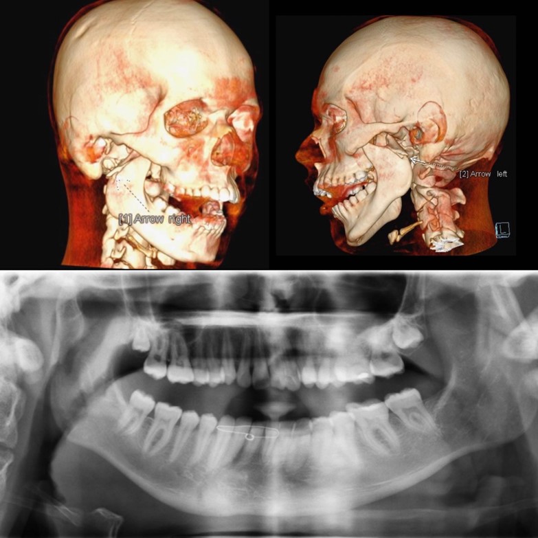 Hình chụp CT của bệnh nhân H.D.R trước khi phẫu thuật. Ảnh FVCC