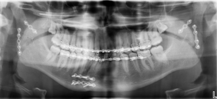 Hình chụp CT sau phẫu thuật của bệnh nhân H.D.R. Ảnh FVCC