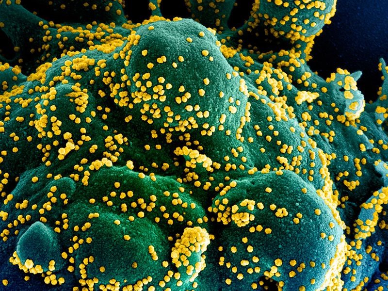 Một tế bào (xanh dương/xanh lục) bị nhiễm nặng các hạt virus SARS-CoV-2 (màu vàng), được phân lập từ bệnh nhân COVID-19 và chụp tại NIAID, Fort Detrick, Maryland, Mỹ. Ảnh: NIAID/AFP